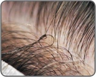 Natalie Laine Ferris - hair transplant in Austin, TX