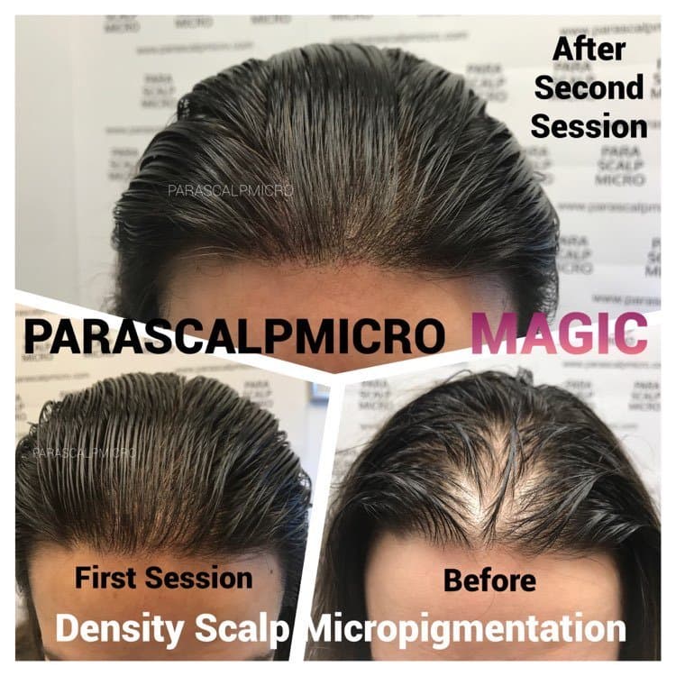 Parascalpmicro - hair transplant in New York, NY