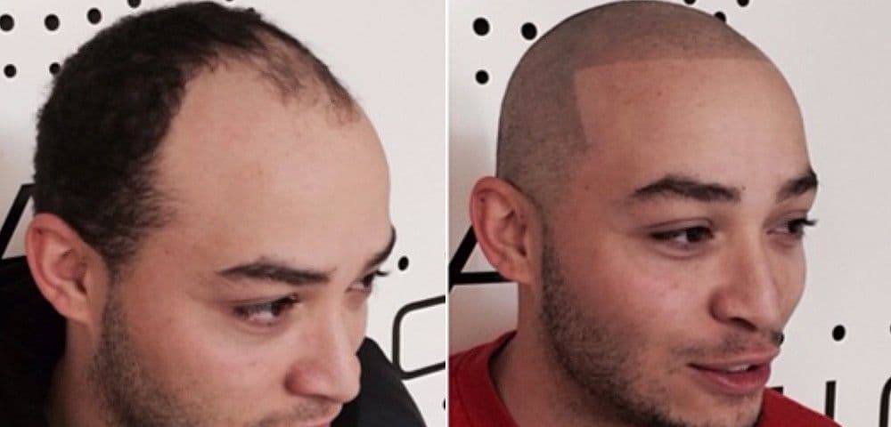 Hair Train Scalp Micropigmentation And Hair Tattoo - hair transplant in Colorado Springs, CO