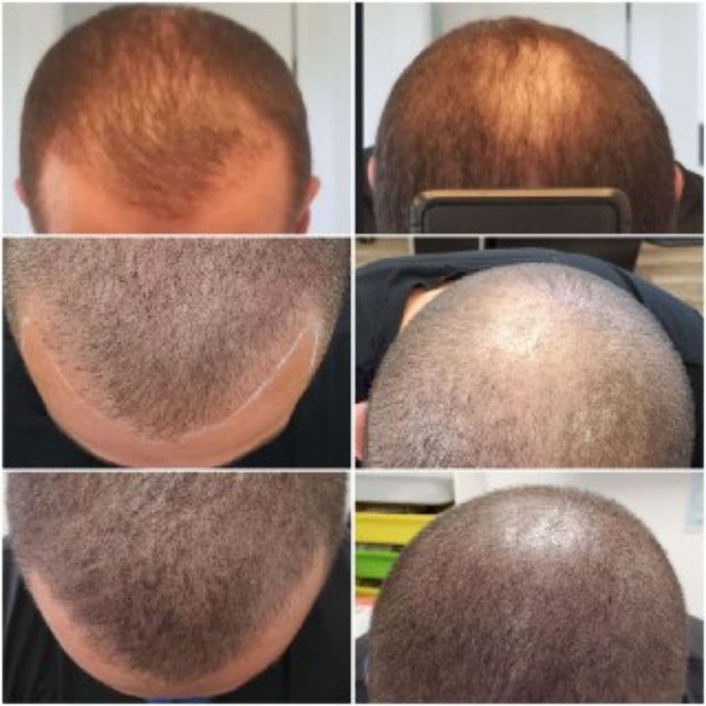 nYou Image Ink - hair transplant in San Jose, CA