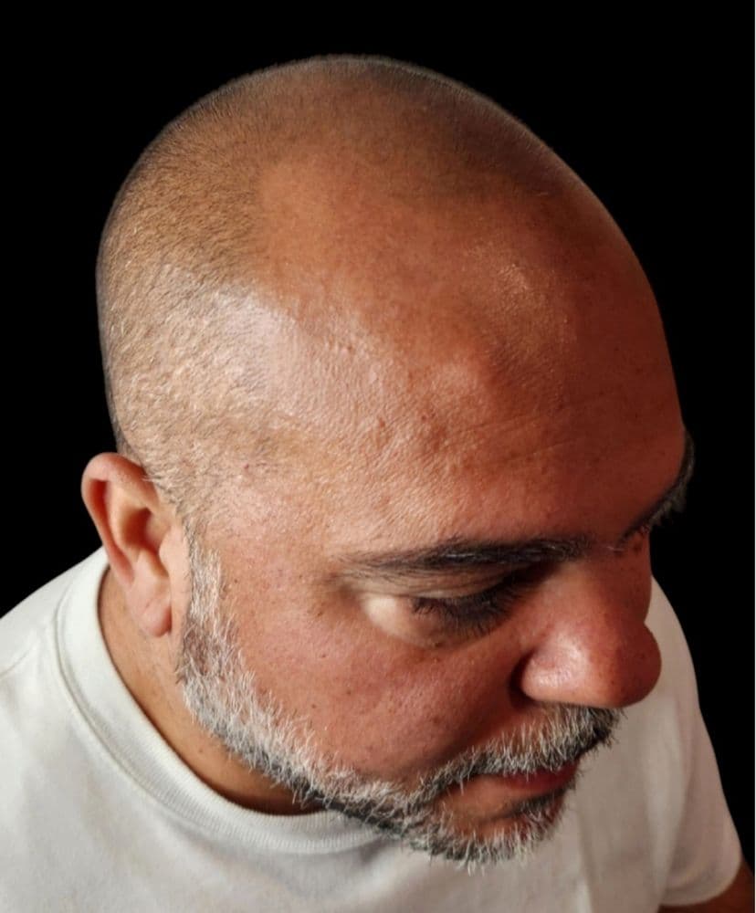 Micro World - hair transplant in Lithia, FL