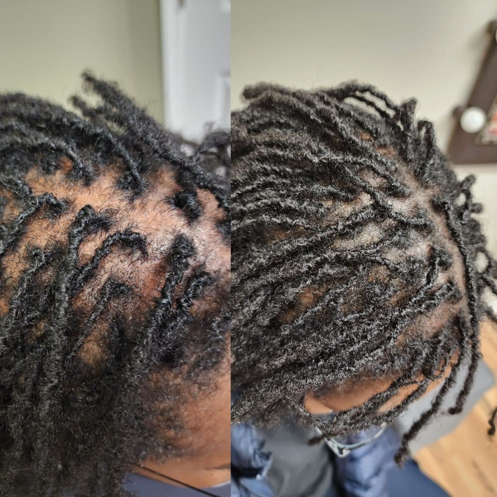 OM SCALP Micropigmentation & Hairline Tattoo Clinic - hair transplant in Chicago, IL