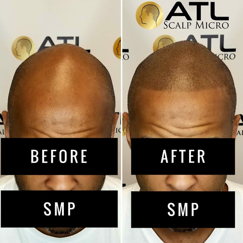 ATL Scalp Micro - hair transplant in Atlanta, GA