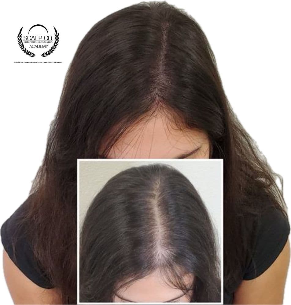 Scalp Co. - hair transplant in Parker, CO