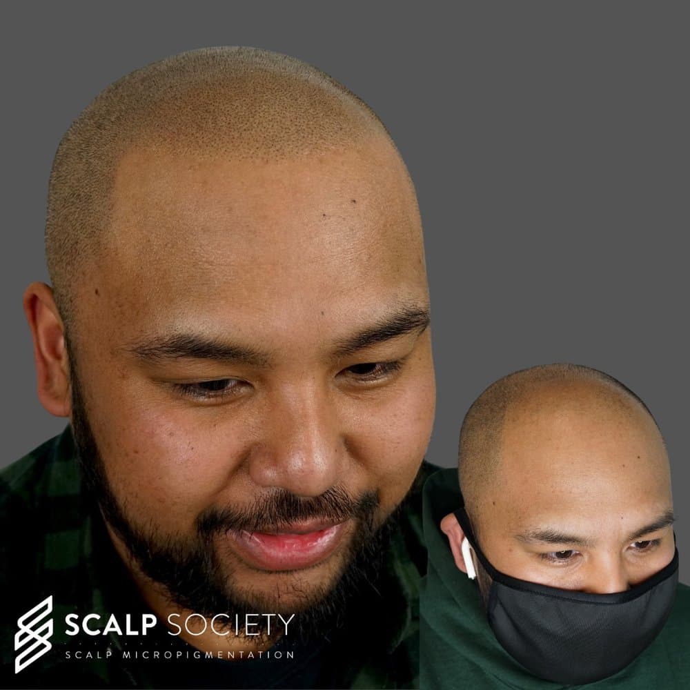 Scalp Society - hair transplant in San Jose, CA