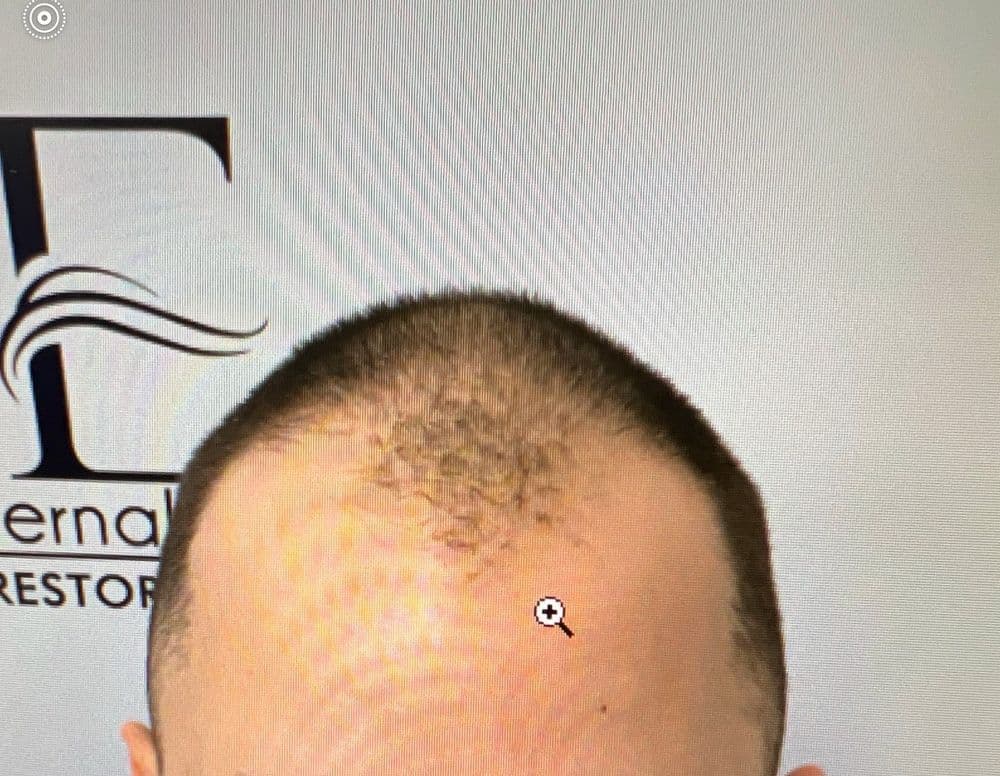 Eternal Hair & Esthetics - hair transplant in Totowa, NJ