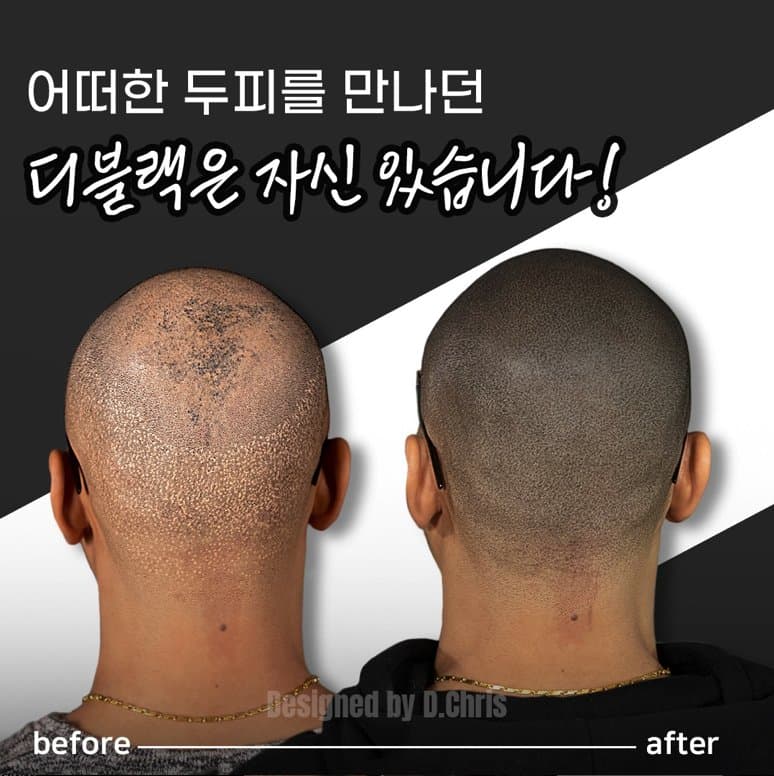 D Black SMP - hair transplant in Lewisville, TX