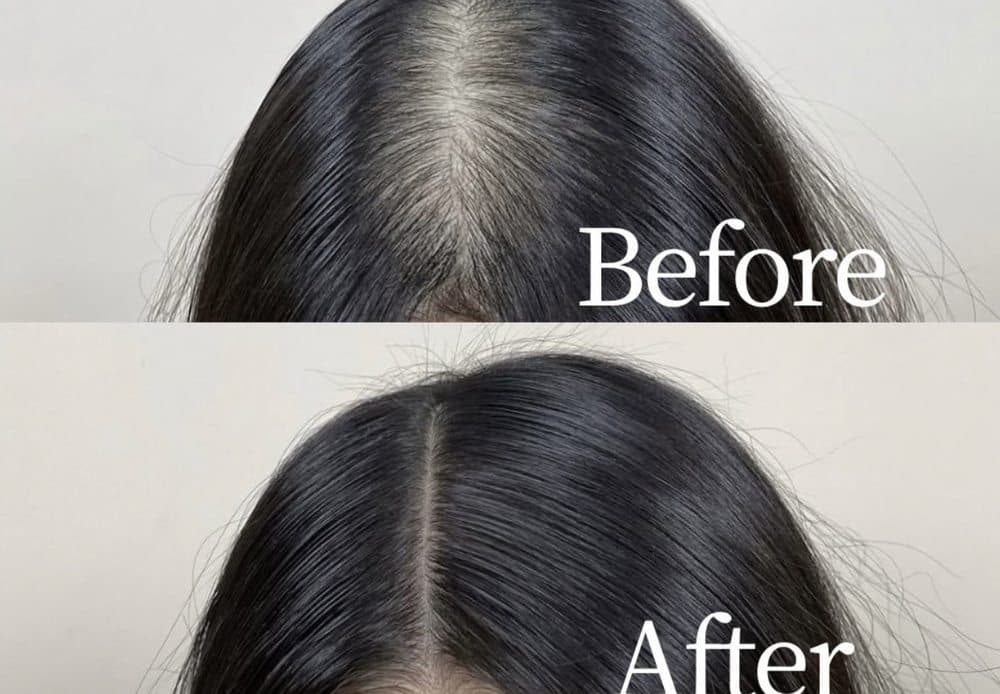 Chaeum SMP - hair transplant in Los Angeles, CA