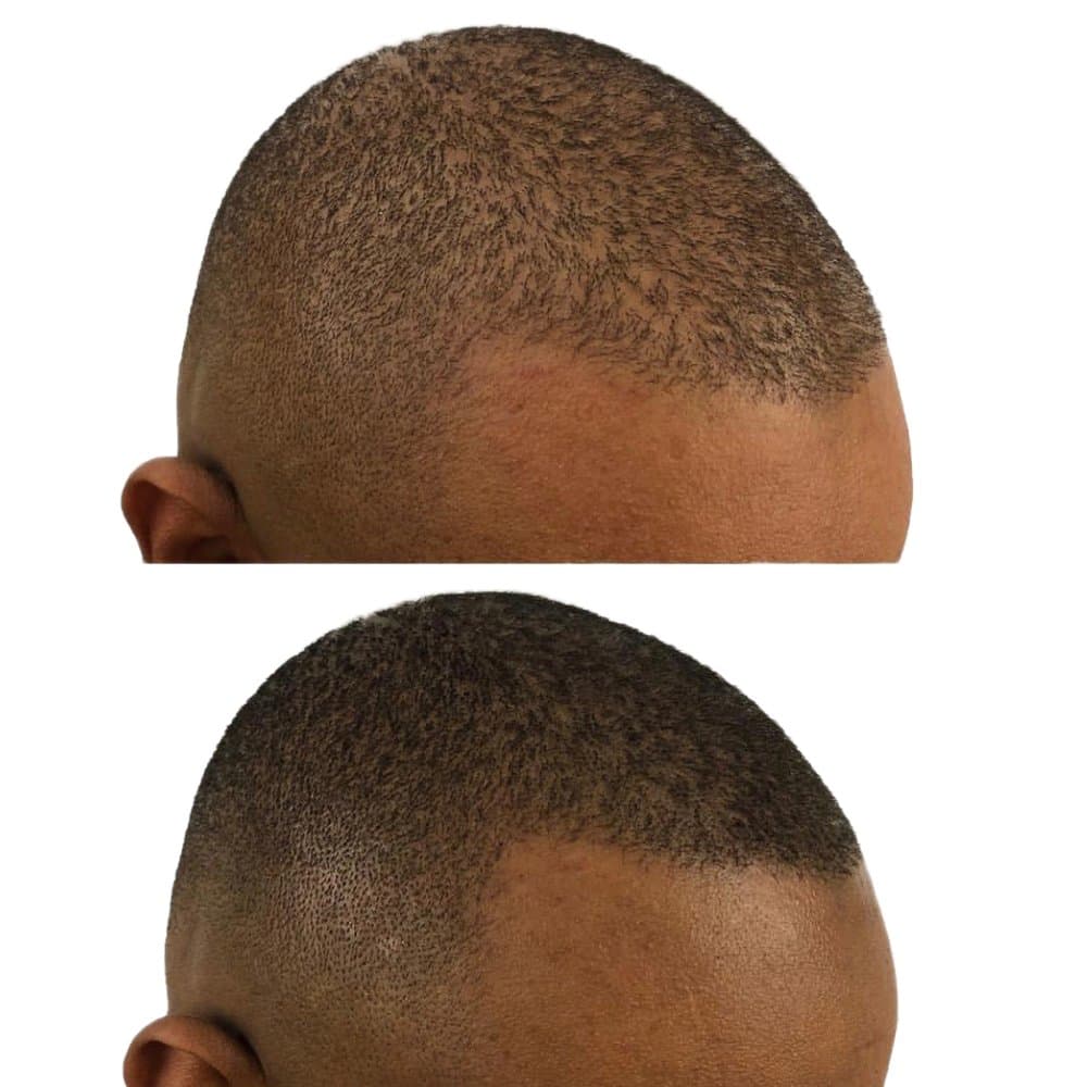 Restoration Hairline Seattle - hair transplant in Seattle, WA