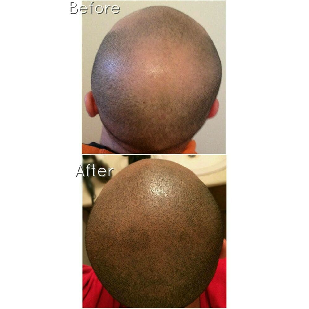 Utah Scalp Micropigmentation Center - hair transplant in Salt Lake City, UT