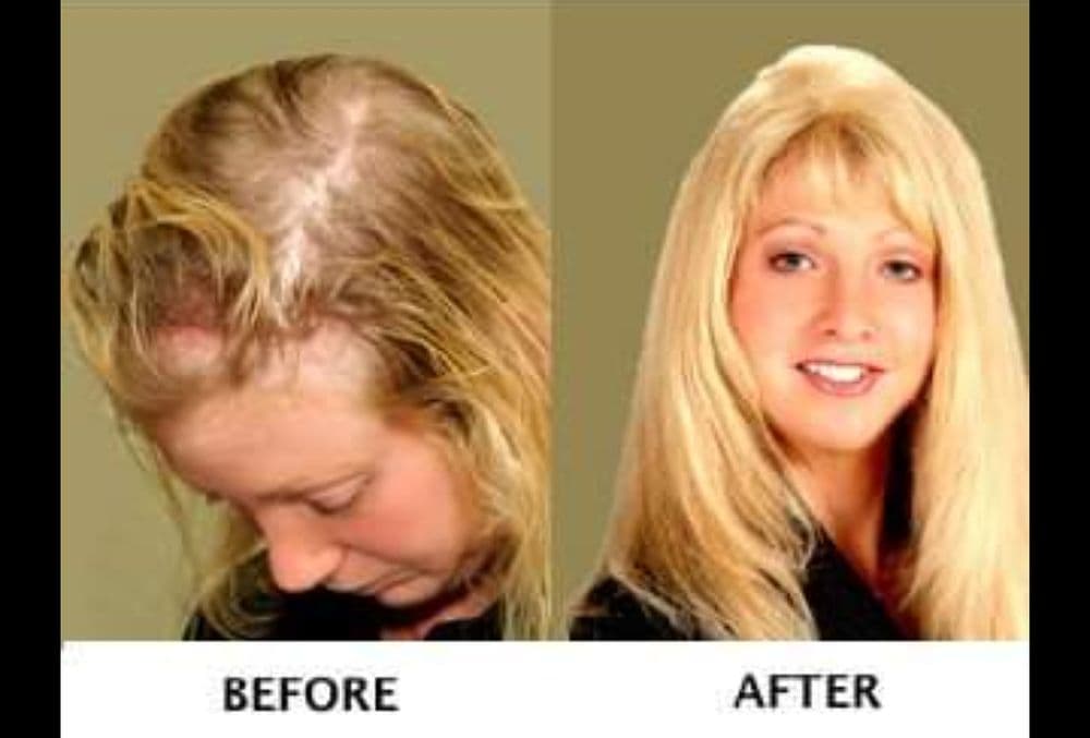 Peggy Tom Hair Replacement - hair transplant in San Francisco, CA