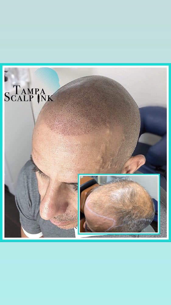 Tampa Scalp INK - hair transplant in Oldsmar, FL