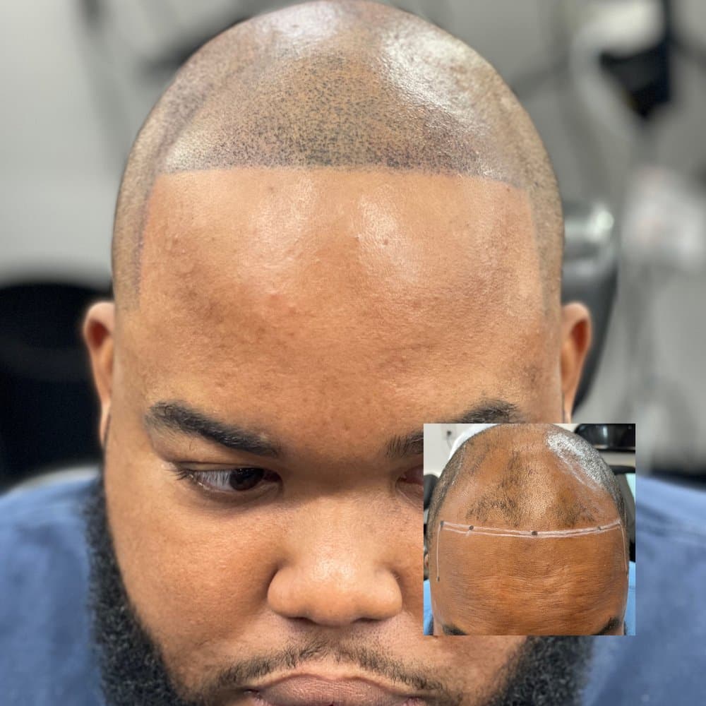 Raleigh SMP - hair transplant in Raleigh, NC