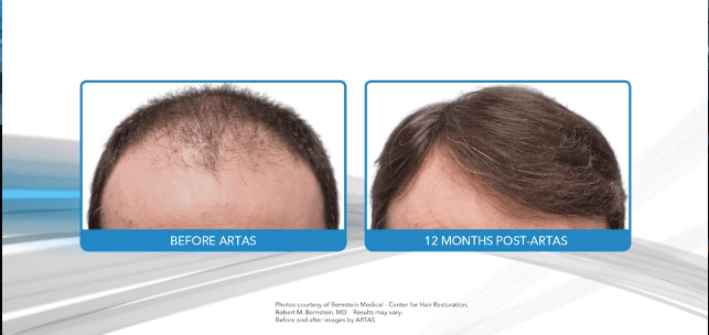 Hair Doc - hair transplant in San Francisco, CA
