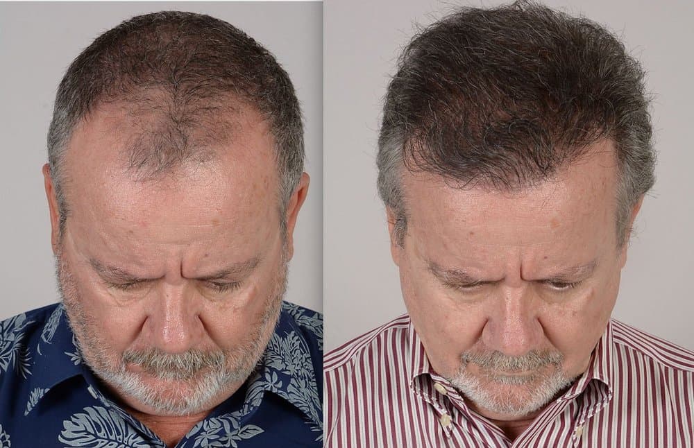 Katona Hair Restoration - hair transplant in Miami, FL