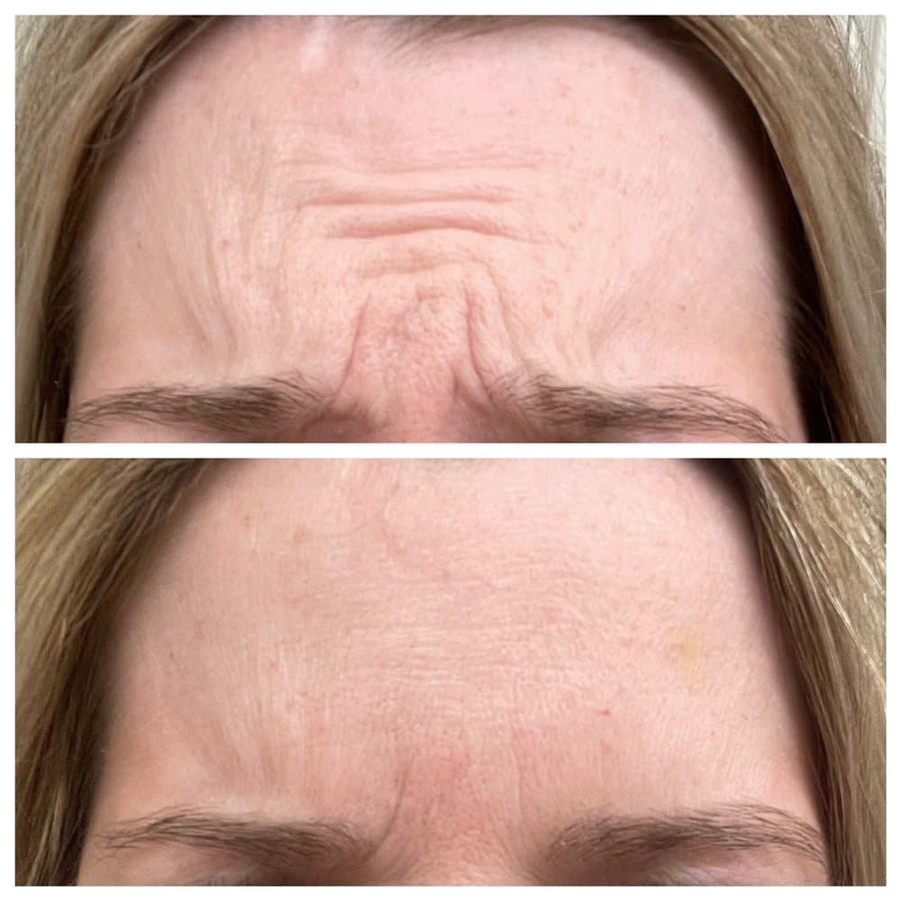 Lakewood Aesthetics - hair transplant in Dallas, TX