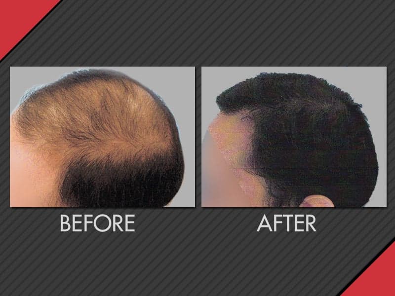 Maxim Hair Restoration - hair transplant in Greenwich, CT