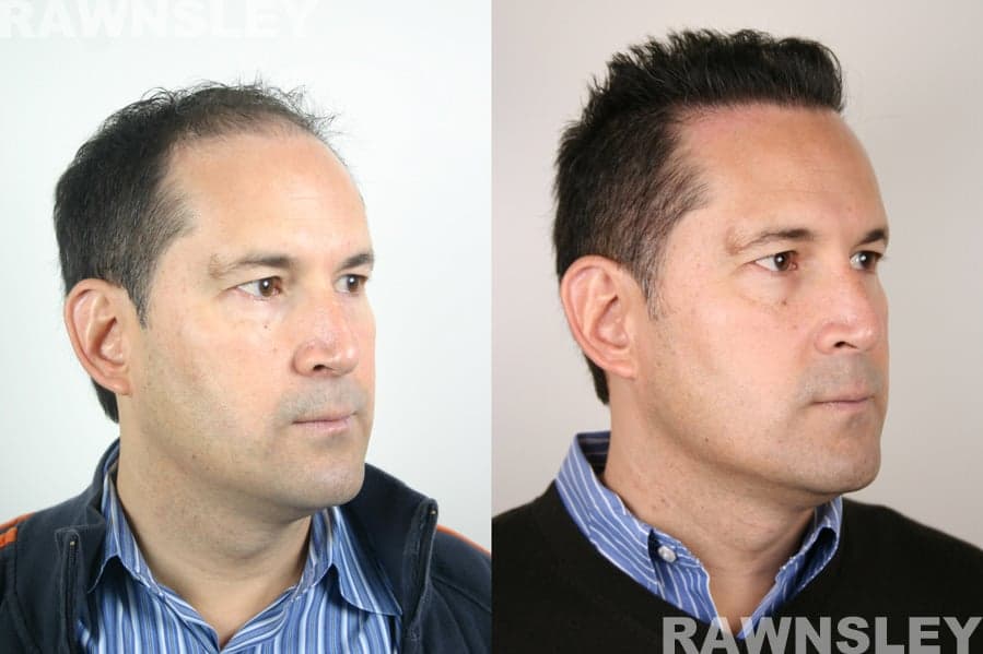 Rawnsley Hair Restoration - hair transplant in Los Angeles, CA