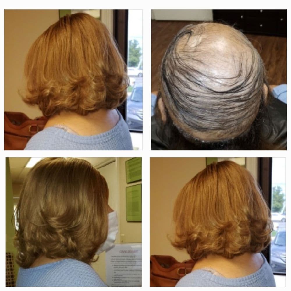 Restore Non-Surgical Hair Replacement Center - hair transplant in Augusta, GA