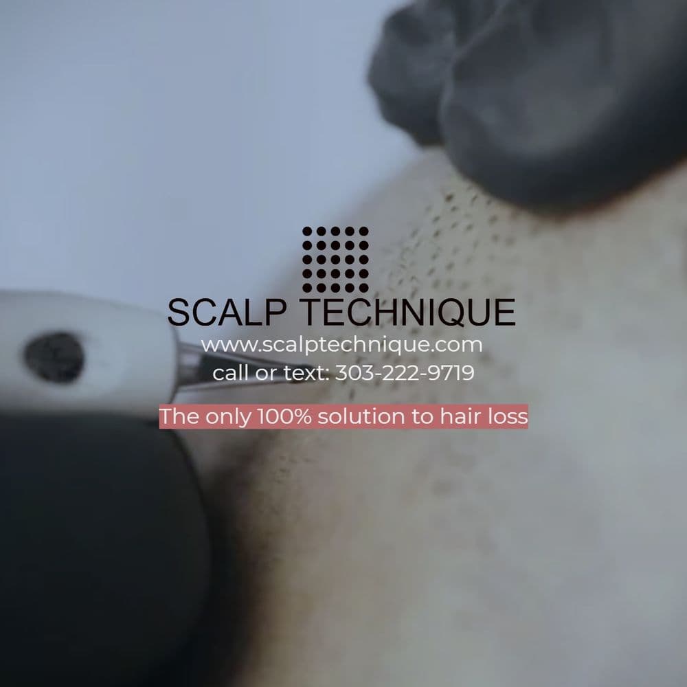 Scalp Technique - hair transplant in Broomfield, CO