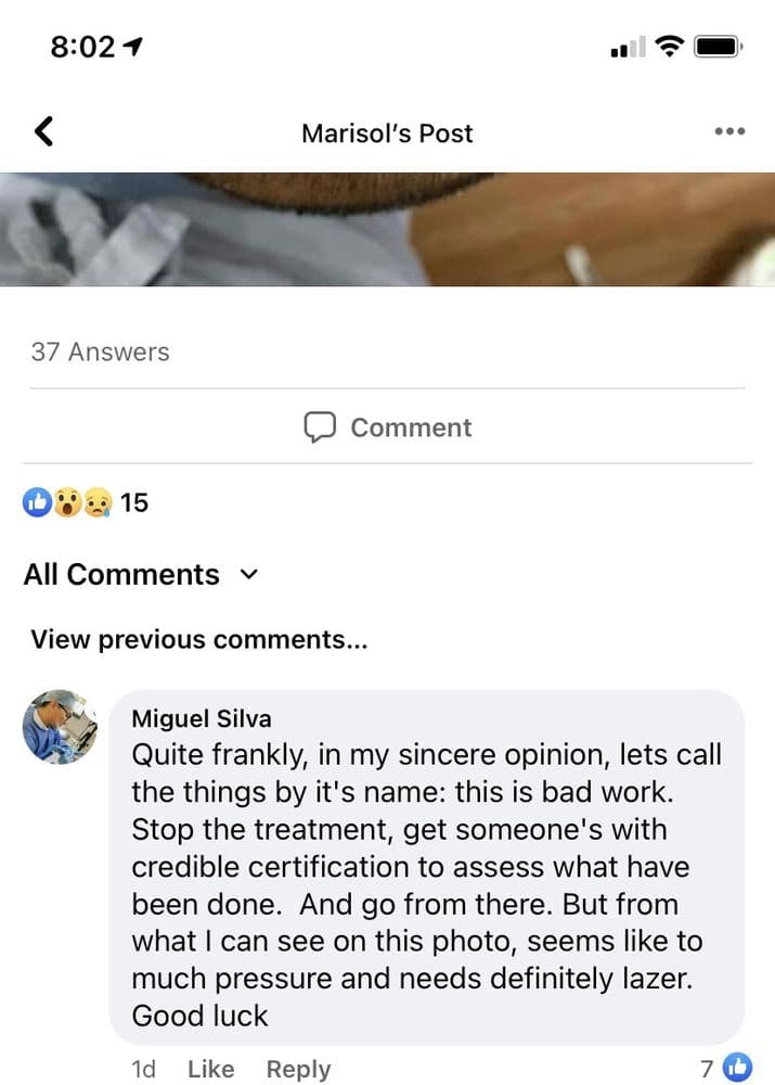 Infinite Follicle Scalp Micro - Pigmentation - hair transplant in Tucson, AZ