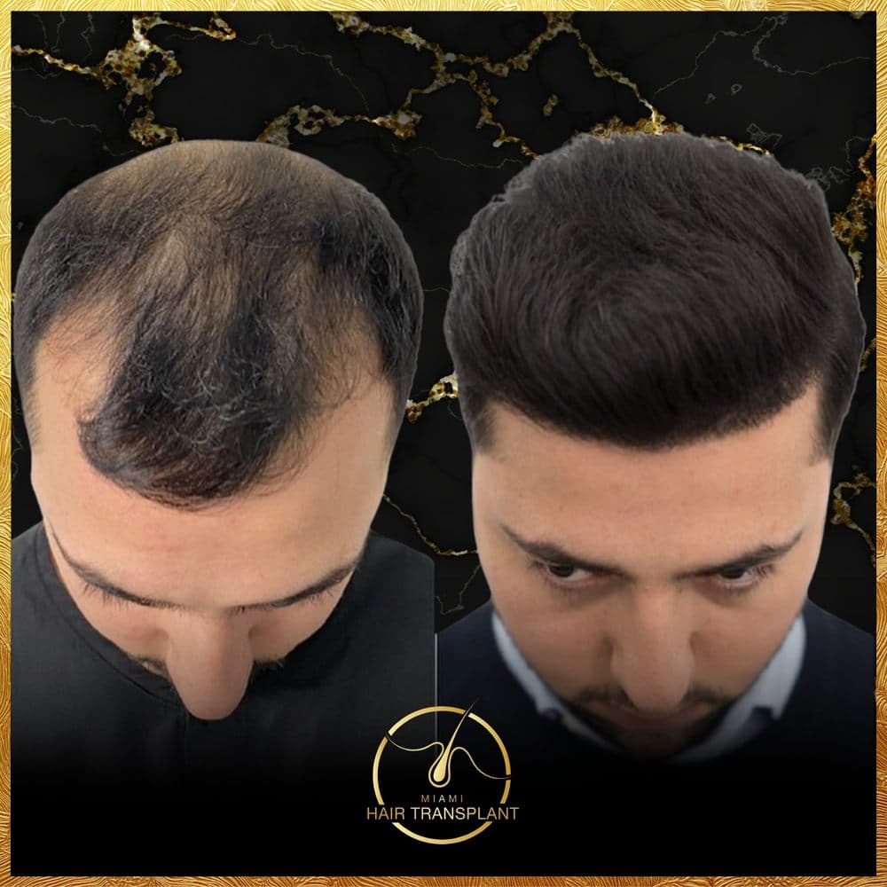 Miami Hair Transplant - hair transplant in Miami, FL