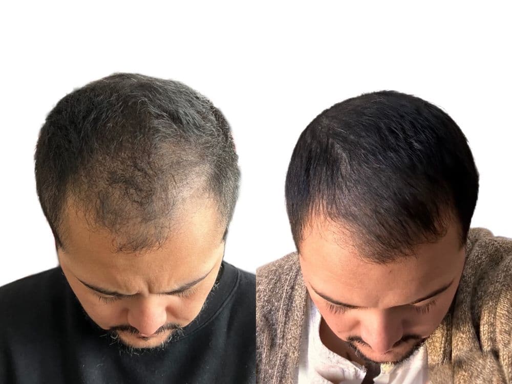 Reshade Scalp Micropigmentation - hair transplant in Brooklyn, NY