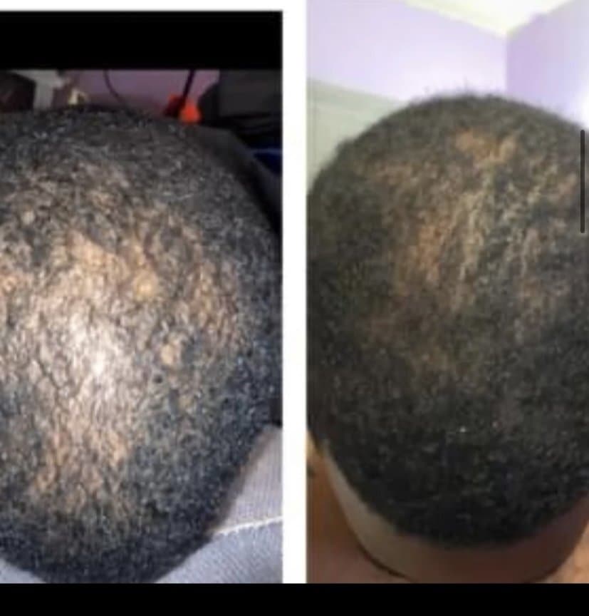 Healing Hands Growth Oil - hair transplant in Jackson, MS