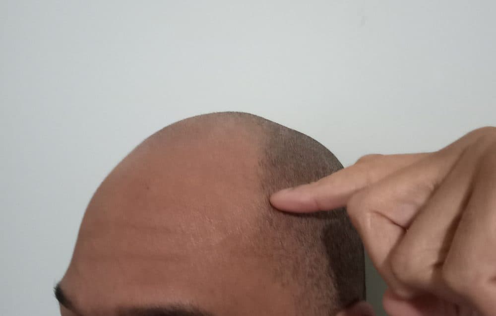 Gerow Hair Ink - hair transplant in New York, NY