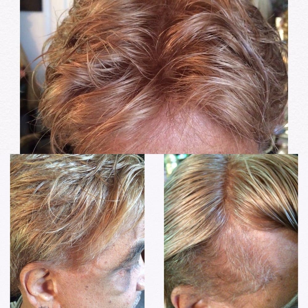 MindBlowing hair replacement - hair transplant in Los Angeles, CA