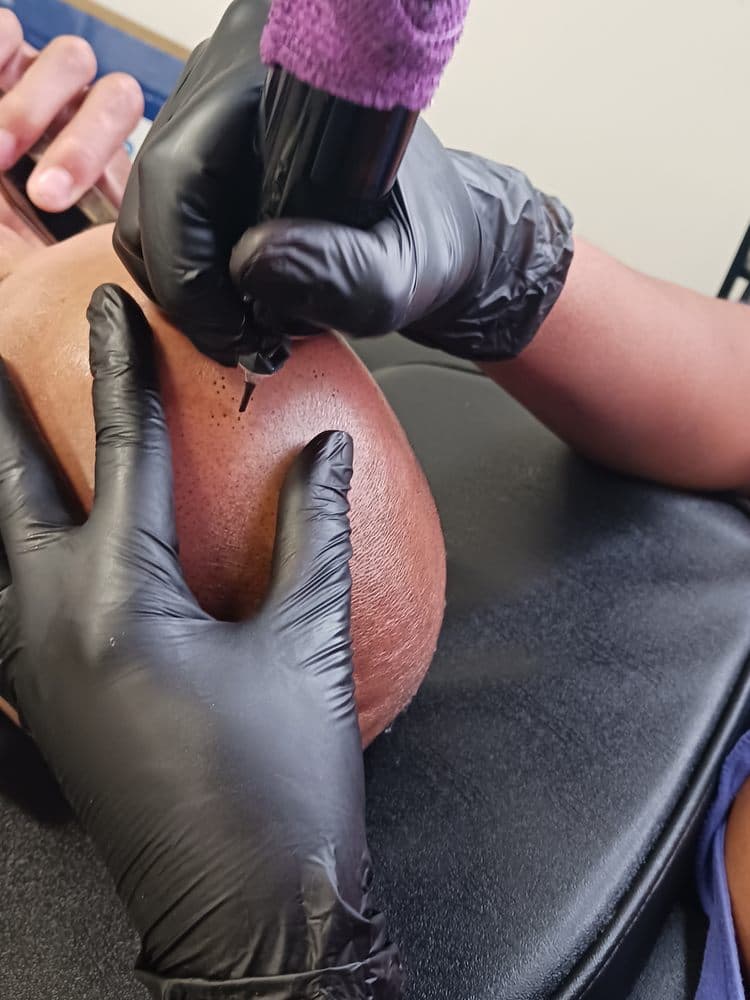 Scalp Conceal - hair transplant in Rockville, MD