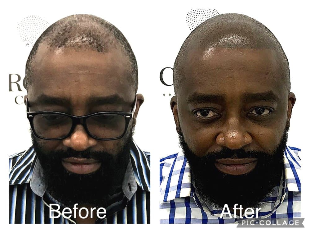 Micro Scalp Clinic - Springfield - hair transplant in Springfield, MA