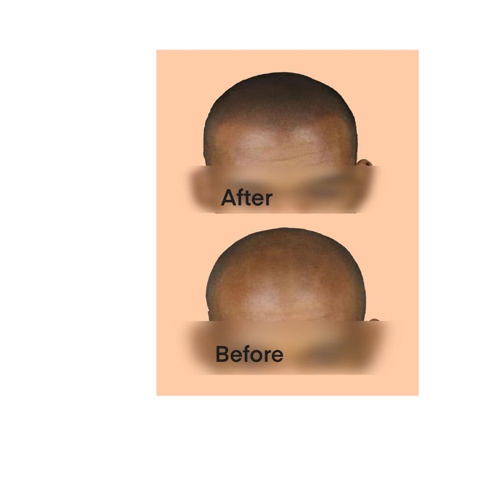 E-SMP Studio - hair transplant in San Jose, CA