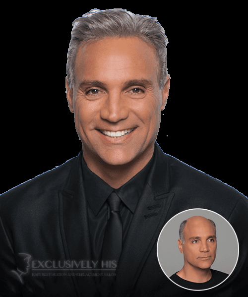 Exclusively His Salon - hair transplant in Cincinnati, OH