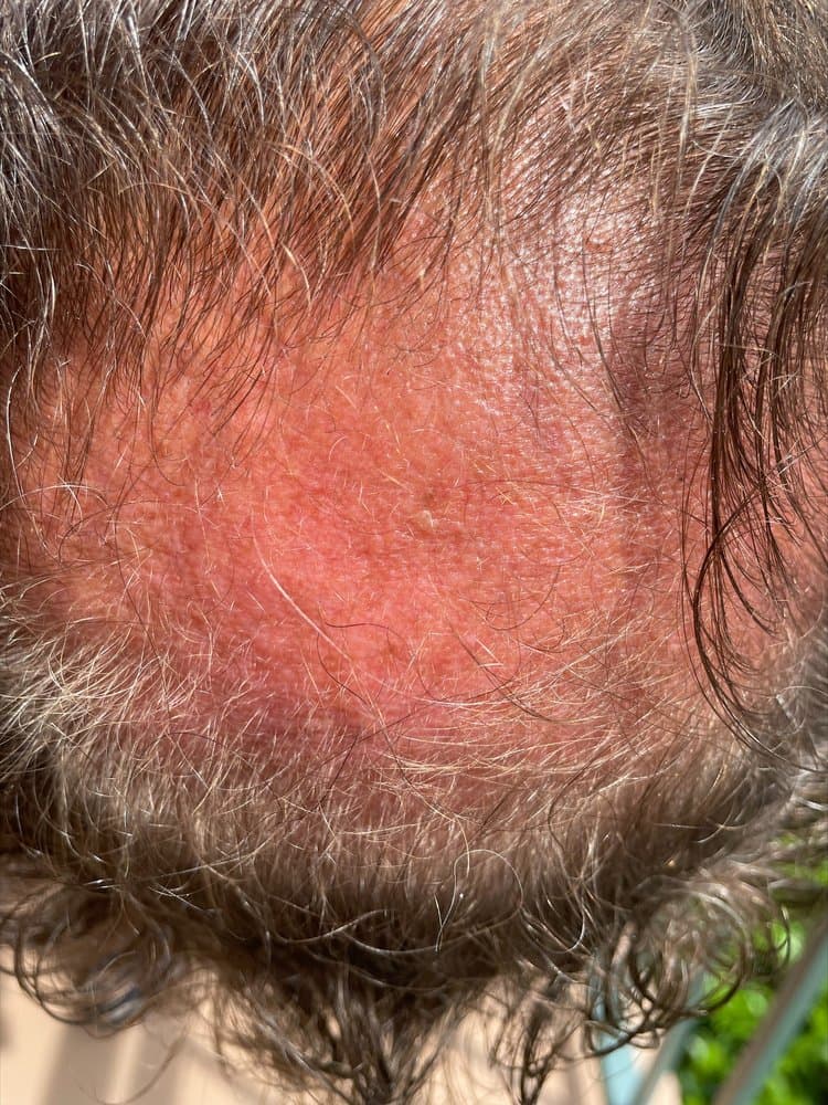 Sa Lu Brious - hair transplant in Marriottsville, MD