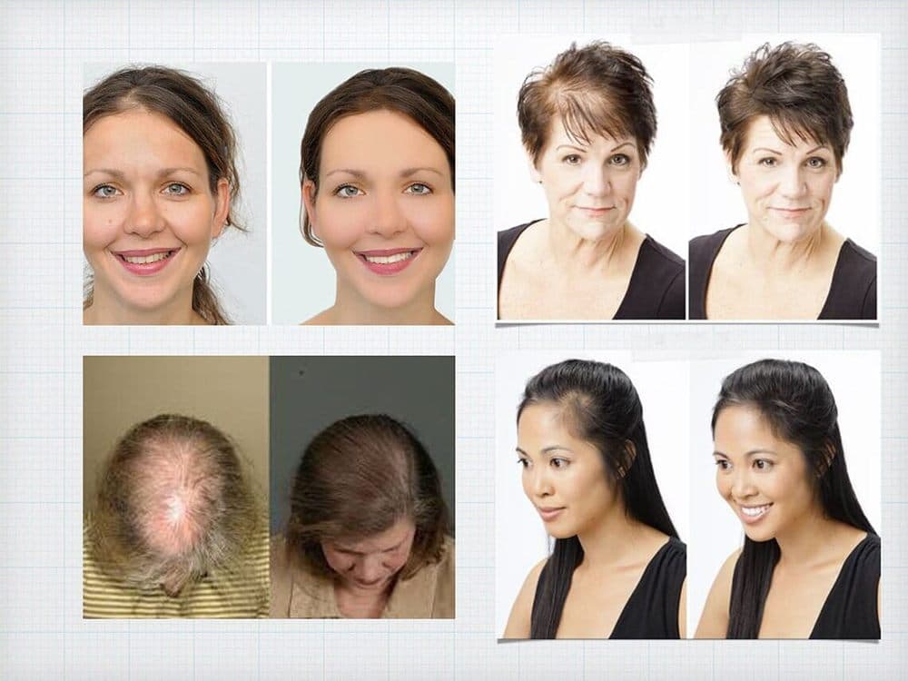 PRP Hair Loss Treatment Center - hair transplant in Plainsboro Township, NJ