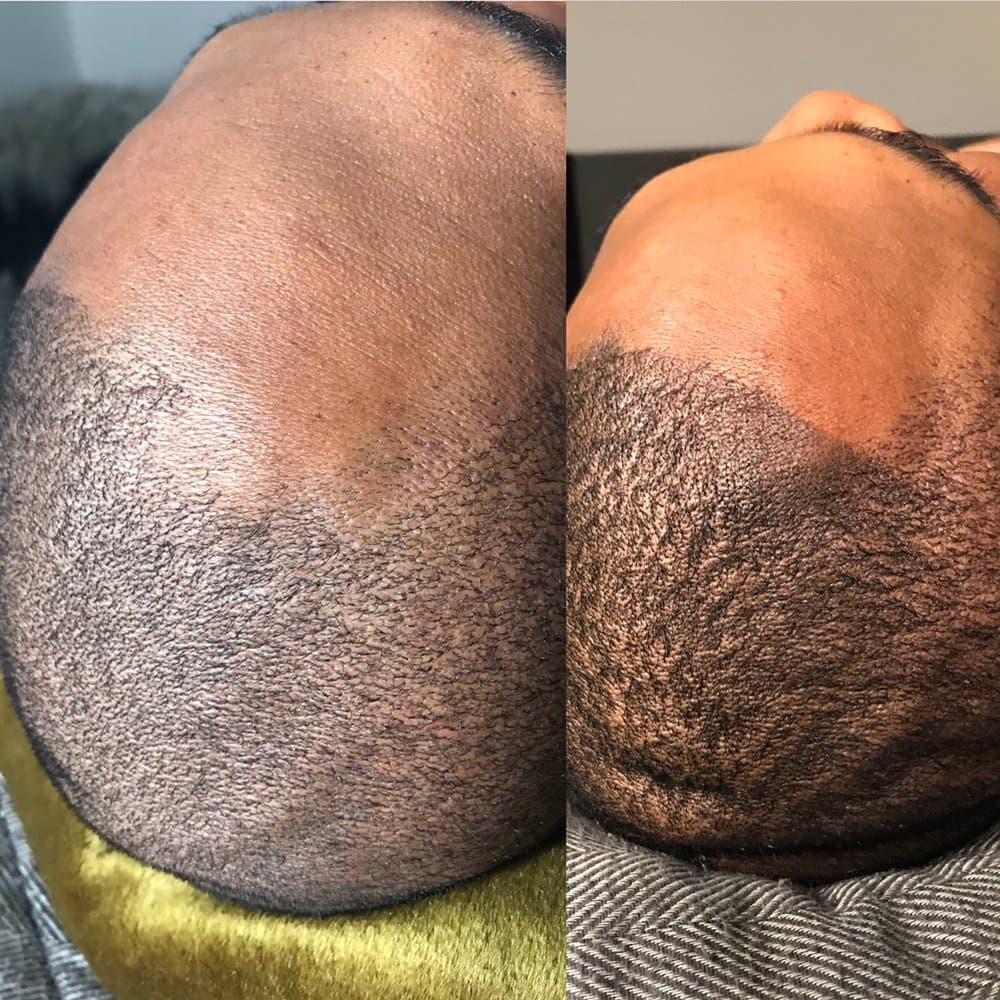 The Scalp Artist - hair transplant in San Diego, CA
