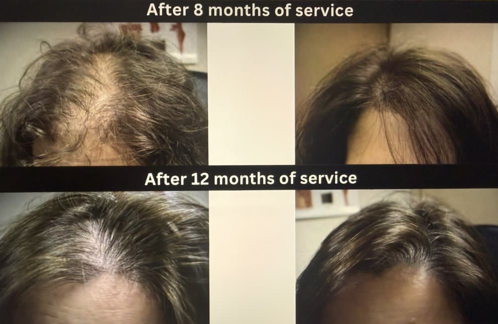 Mill Creek Hair Loss Solutions - hair transplant in Mill Creek, WA