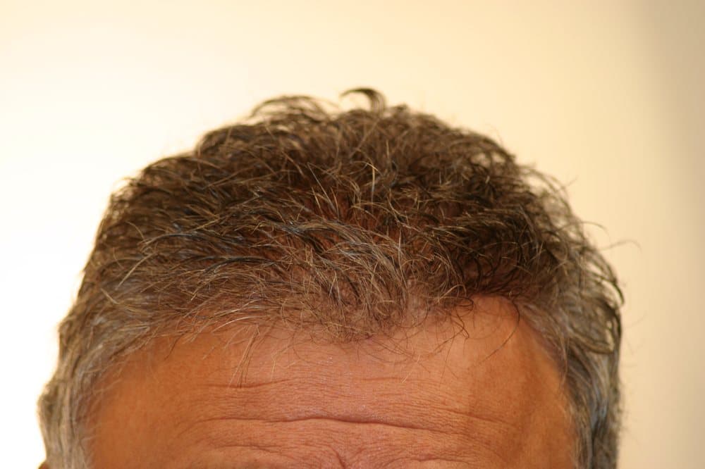 Attis Hair - hair transplant in Overland Park, KS