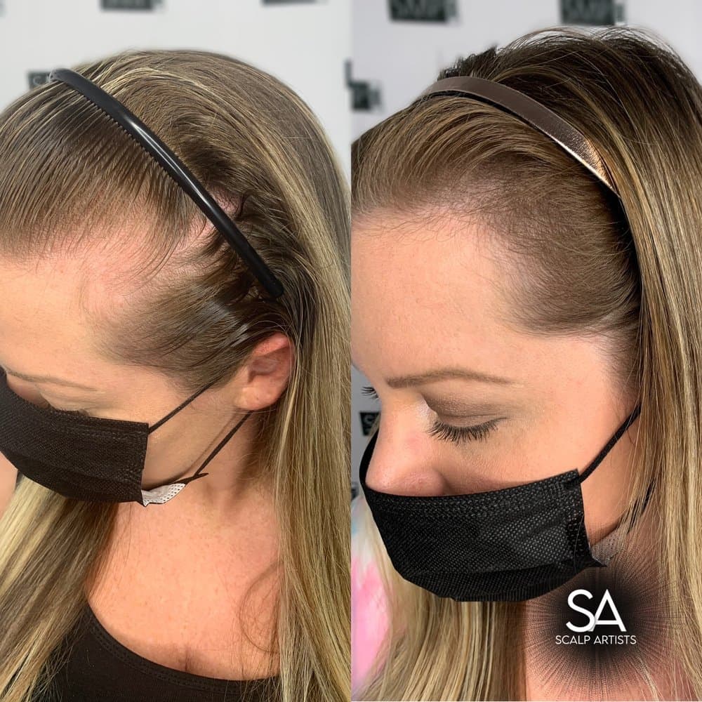 Scalp Artists - hair transplant in Las Vegas, NV