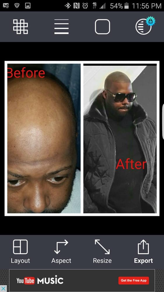 Baltimore Scalp Pigmentation - hair transplant in Timonium, MD