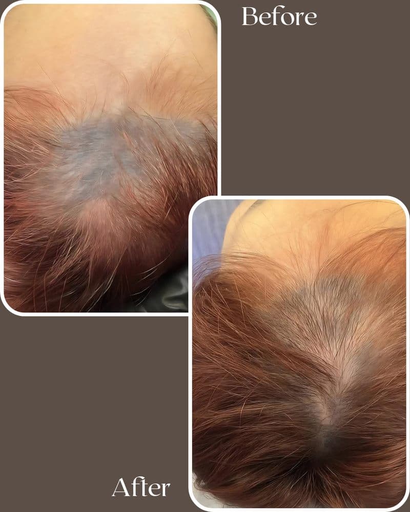 RenewLab - hair transplant in San Jose, CA