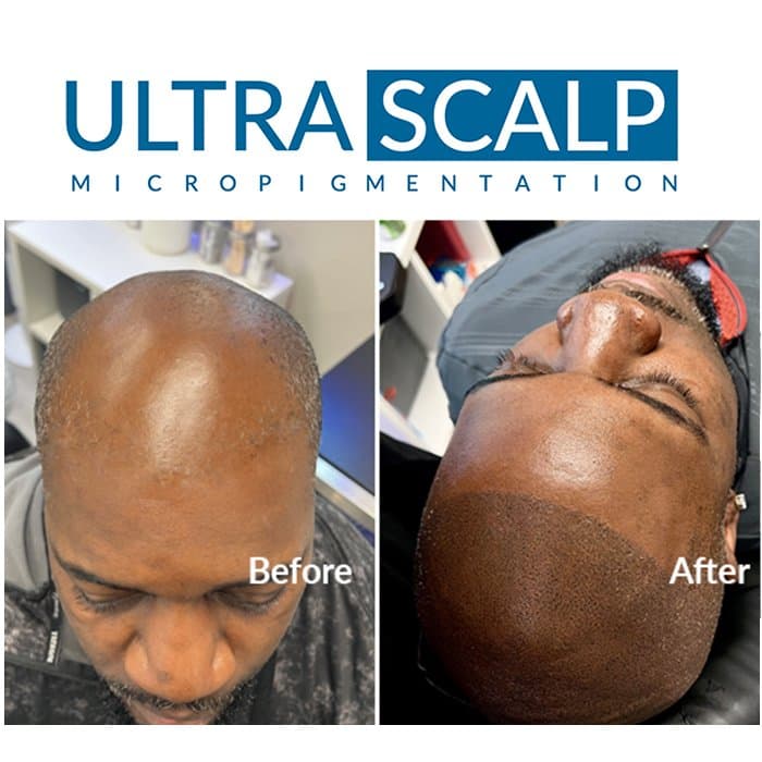 Ultra Scalp Micropigmentation - hair transplant in Tampa, FL