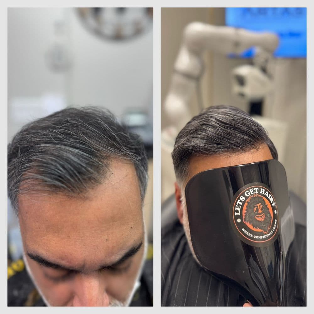 Let’s Get Hairy - hair transplant in New York, NY