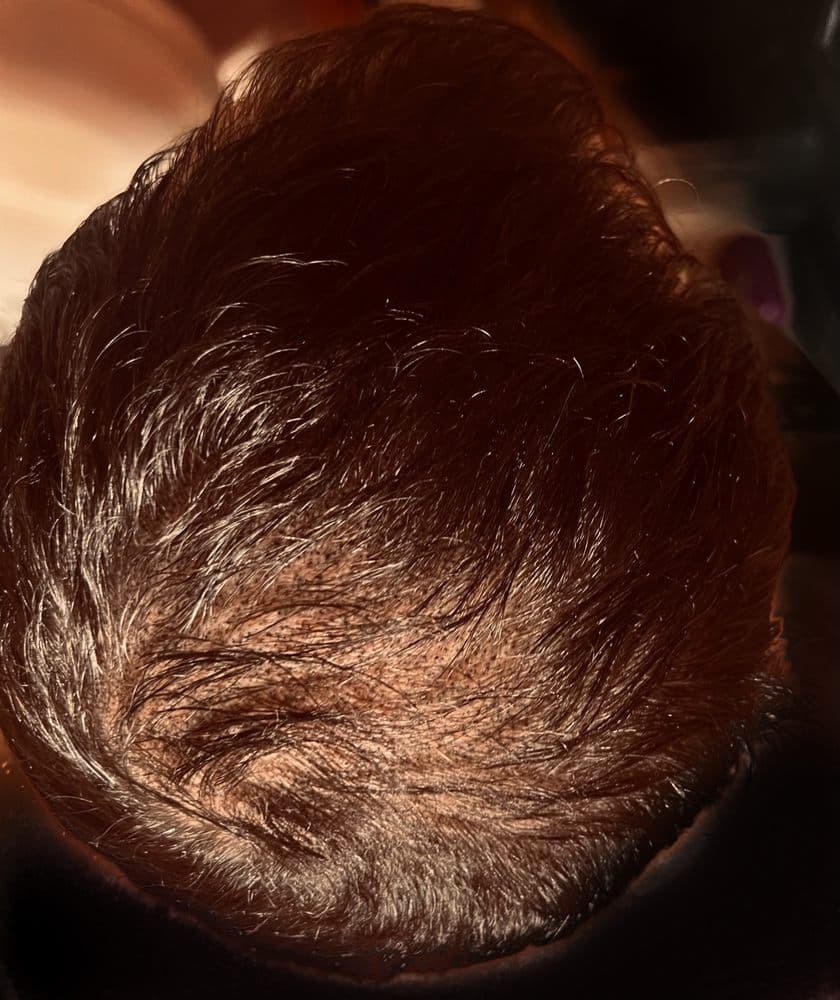 Joyfulink - hair transplant in Roseville, CA