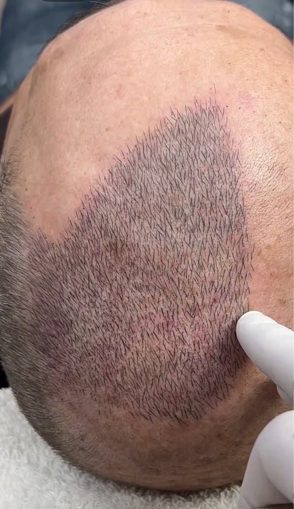Hold Fast Scalp Micropigmentation - hair transplant in Midlothian, TX
