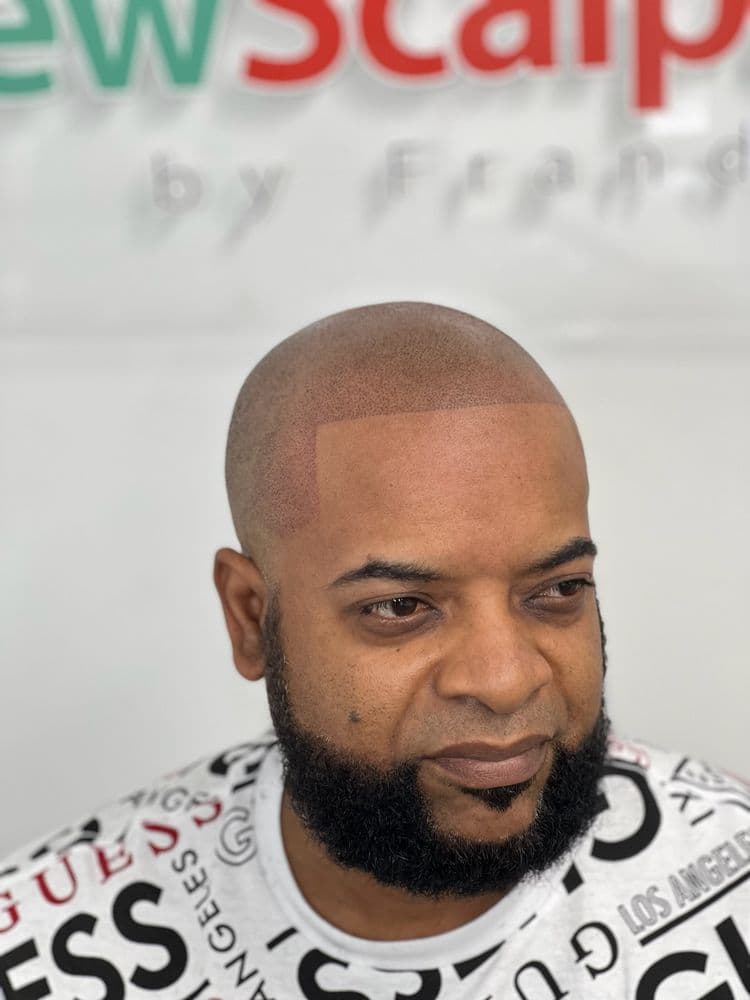 NEW SCALP SMP - hair transplant in Miami, FL