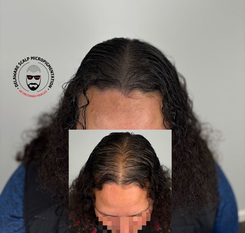 Delaware Scalp Micropigmentation - hair transplant in Wilmington, DE