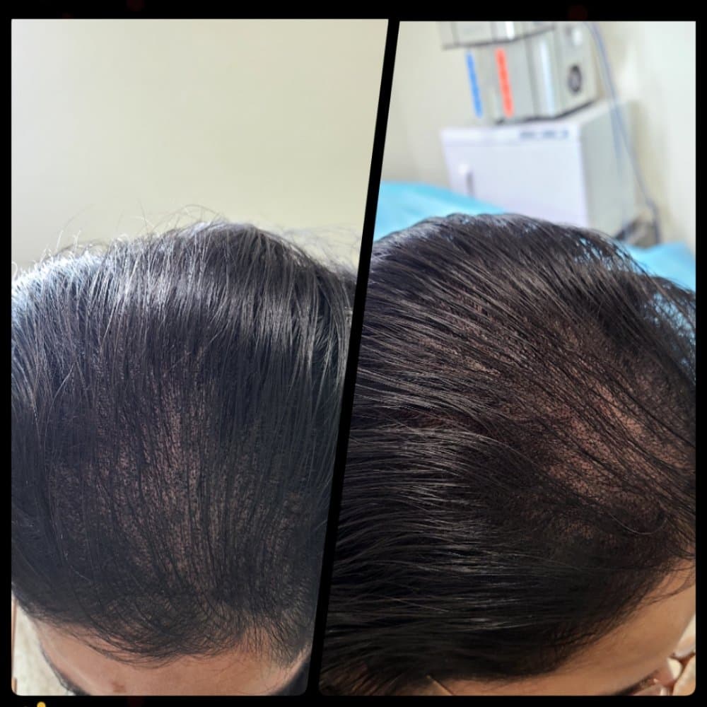 Modern Hair SMP - hair transplant in West Jordan, UT