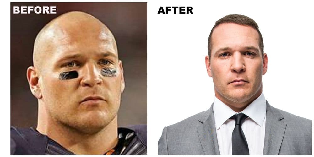 Restore Hair Transplant & Restoration - hair transplant in Schaumburg, IL